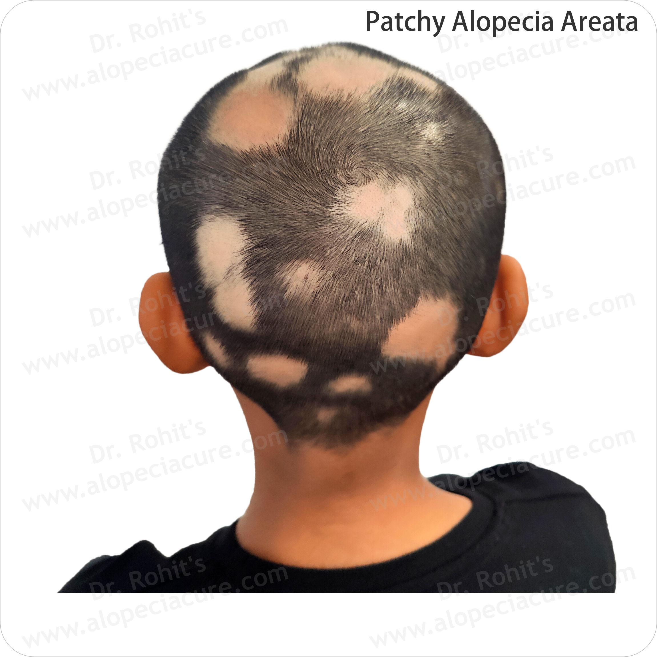Hair Regrowth Success